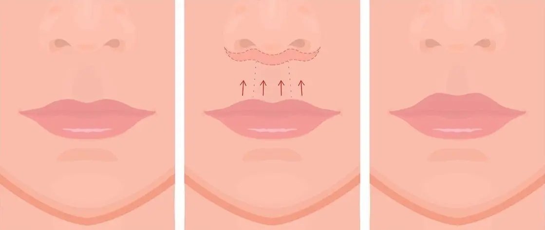Lip Lift surgery